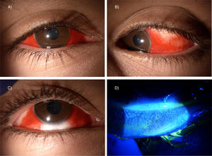 Manifestaciones oculares por sarampión: conjuntivitis hemorrágica bilateral. A-C)Hiposfagmas no globulosos de predominio nasal y temporal. D)Reacción folicular subtarsal inferior.