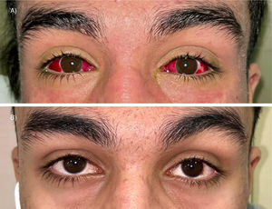 Evolución de las manifestaciones oculares en contexto de infección por sarampión. A)Conjuntivitis hemorrágica en ambos ojos. B)Veinte días más tarde, resolución de la afectación ocular.