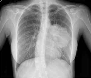 Radiografía de tórax: masa mediastínica anterior izquierda de bordes lobulados. Dudosas adenopatías hiliares izquierdas.