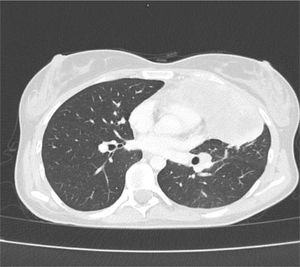 TAC toracoabdominopélvico: masa heterogénea en mediastino anterosuperior izquierdo, de 11,8×9,9×9,9cm.