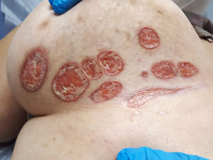 Úlceras múltiples, ovaladas y redondeadas, en región submamaria en una mujer de 76 años que había estado aplicando un ungüento con neomicina, triamcinolona y nistatina de forma ininterrumpida durante un año.