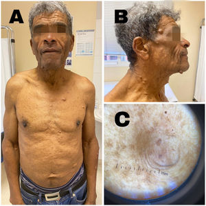 A)Parte anterior del paciente donde se observan múltiples neurofibromas en tronco, abdomen y extremidades superiores. B)Lateral de región facial y cervical donde se observan neurofibromas de distinto tamaño. C)Imagen con dermatoscopia de un neurofibroma, apreciándose lesión sobreelevada de componente quístico con efélides en su superficie. Los autores cuentan con el consentimiento oral y escrito del paciente para la publicación de las presentes imágenes.