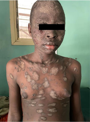 Hyperkeratotic plaques with scaling on the trunk, face, and arms.