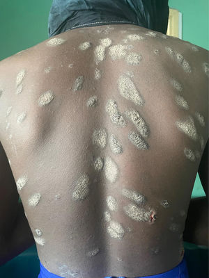 Hyperkeratotic plaques with scaling on the back.