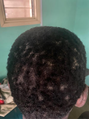 Hyperkeratotic plaques on the scalp without alopecia.