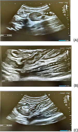 (A) Adenopatía 15mm en region ileocecal. (B) Engrosamiento patológico (4,2mm) de los últimos 10cm de ileon. (C) Pared de colon derecho en límite alto de la normalidad.