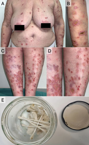 Clinical presentation of the lesions and ‘matchbox sign’. (A–D) Ulcers of widespread distribution, linear and sinuous patterns, converging in geometric arrangements, with well-defined borders and fibrinous exudate on their surface. (E) Glass container brought by the patient where she reported storing parasites (matchbox sign).