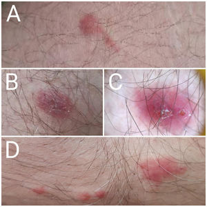 Máculas eritematoedematosas y el «signo de la cometa» en un paciente con infección por Pyemotes spp. Pápulas eritematoedematosas observadas en el paciente. A, B y C) Miembros inferiores. D) Abdomen. La imagen A destaca un trayecto lineal conocido como el «signo de la cometa», característico de esta dermatitis.