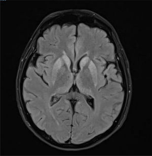 RMN cerebral secuencia T2 FLAIR: hiperseñal de los ganglios de la base, ínsula de forma bilateral y núcleo dorsomedial del tálamo.