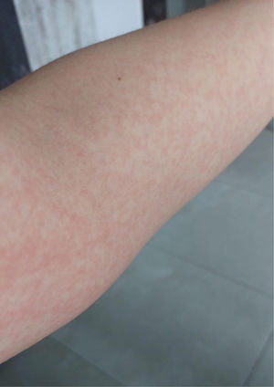 Exantema en los antebrazos.