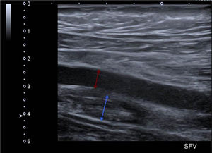 Ecografía Doppler del miembro inferior izquierdo. La vena femoral superficial tiene contenido sólido endoluminal en relación con trombosis aguda (flecha azul). La arteria femoral vecina está señalada con una flecha roja.