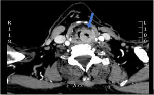 CT scan: Tumor in the left pyriform sinus (25mm×25mm×53mm) that partially obliterates the airway, leaving a 4-mm transverse axis passage at the level of the thyroid cartilage. The arrow indicates the location of the tumor.