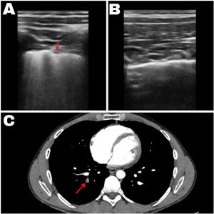 (A) Ecografía pulmonar correspondiente a la zona anatómica posteroinferior derecha del paciente que muestra numerosas líneas B y una consolidación subpleural en forma de cuña bien delimitada, señalado por la flecha. (B) Ecografía pulmonar con líneas A normales en el resto del parénquima pulmonar. (C) Angiotomografía computarizada pulmonar donde se observa un trombo en el vaso señalado por la flecha.
