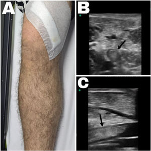 (A) Imagen clínica del miembro inferior derecho. (B) Ecografía venosa en corte transversal, y (C) en corte longitudinal de la vena poplítea derecha. Las flechas en las imágenes B y C señalan el material hiperecogénico en el interior de la vena poplítea correspondiente al trombo venoso.