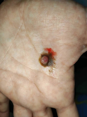Pápula rosada sobre una mancha marronácea en la palma de la mano izquierda.