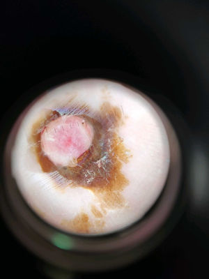 Hallazgos dermatoscópicos: lesión central rosada rodeada por una mancha marronácea cuyo pigmento se encuentra ocupando los dermatoglifos de la palma de la mano.