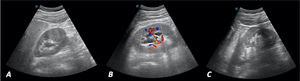 A) Corte longitudinal. Riñón derecho con dilatación pielocalicial sugerente de hidronefrosis grado II/IV. B) Corte longitudinal. Doppler de riñón derecho negativo que confirma la dilatación existente. C) Corte longitudinal. Riñón izquierdo normal, sin observar dilatación pielocalicial.