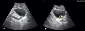 A) Corte longitudinal. Imagen anecoica a la entrada de la vejiga, que corresponde al uréter dilatado. B) Corte longitudinal. Vejiga bien replecionada con imagen anecoica, con borde hiperecoico bien definido (imagen quística) que sugiere ureterocele. En su interior imagen hiperecoica con sombra acústica posterior de 9,76mm compatible con litiasis.