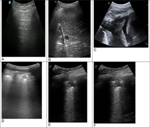 Imágenes de neumonía en la ecografía pulmonar. La imagenA muestra un pulmón sin patología valorado con un ecografía de mano en un domicilio de un paciente, donde se visualizan las líneasA. La imagen B visualiza un pulmón con aspecto de hígado (pulmón hepatizado) asociado a un derrame pleural. En la imagen C se objetiva una hepatización del pulmón con broncograma aéreo y derrame pleural asociado. La imagen D muestra un imagen redonda y heterogénea justo por debajo de la línea pleural, correspondiente a un proceso infeccioso. La imágenes E y F muestran esa condensación subpleural que deforma la línea pleural y además condiciona una disminución del deslizamiento pleural. Fuente: imágenes propias.