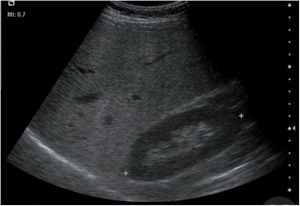 Ecografía hepática. Corte longitudinal a nivel de hipocondrio derecho. Se visualiza un aumento de ecogenicidad del parénquima hepático en comparación con el parénquima renal subyacente, compatible con esteatosis hepática leve.