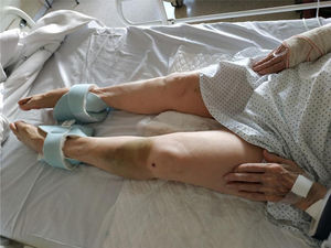 Imagen clínica de la paciente al ingreso, con rigidez distal y equimosis en extremidad inferior derecha. La equimosis visible en la extremidad inferior corresponde a un hallazgo incidental, sin relación con el cuadro electrolítico.