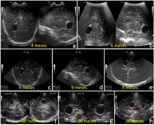 a) Izquierda: imagen ecográfica tomada desde la fontanela anterior, permeable, a los cuatro meses de edad, mediante corte coronal con inclinación posterior del transductor microconvex, donde se visualiza una sección frontal del QPC grande. Derecha: corte parasagital derecho con visualización longitudinal y oblicua, desde el mismo lugar e igual sonda que el anterior. b) Imagen similar a la anterior tomada a los seis meses de edad, con fontanela aún permeable, mediante sonda convex. c) Imagen del QPC obtenida a los nueve meses de edad, con fontanela bregmática cerrada, con sonda sectorial, mediante corte coronal con inclinación posterior a nivel fontanela anterior. d) Corte parasagital derecho tomado al mismo nivel, con igual sonda y a la misma edad que la anterior. e) Corte axial desde la escama temporal derecha con igual sonda y a la misma edad que las anteriores; ilustra una sección transversal del QPC. f) Imágenes del QPC captadas desde la escama del hueso temporal derecho, con sonda sectorial, a los 20 meses de edad. Izquierda: corte axial; derecha: corte longitudinal que ilustra una sección frontal del cráneo. g) Imagen anterior ampliada, con disminución de la profundidad de la imagen en la pantalla del equipo. h) Corte axial desde la escama temporal derecha con Doppler color, que confirma el contenido líquido, avascular, del QPC. Nótese el tamaño estable del mismo en los diferentes controles, que implica su buen pronóstico.