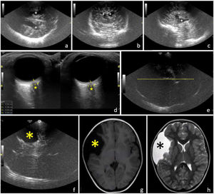a-c) Imágenes ecográficas de cortes transcraneales obtenidos con sonda sectorial (3-5MHz) en un paciente de 13 meses de edad afecto de PCI. a) Corte axial con el transductor colocado en la escama del hueso temporal derecho: ventrículos laterales dilatados (asterisco) e hiperecogenicidad periventricular (LPV). b) Corte coronal con el transductor colocado en la fontanela anterior a nivel del tronco encefálico: hallazgos similares al corte previo. c) Corte sagital con el transductor situado en el mismo lugar que en el corte anterior: III ventrículo dilatado (estrella) y LPV. d-h) Imágenes de una paciente de 8,5 años de edad que consulta por presentar cuadro de cefalea creciente de dos semanas de evolución. d) Ecografía orbitaria con cuantificación normal de la vaina de ambos nervios ópticos (estrella) e) Ecografía transcraneal a nivel de la escama temporal derecha donde no se aprecia desplazamiento de la línea media (línea de puntos discontinua). f) Imagen ecográfica de corte transcraneal con sonda sectorial (3-5MHz) a nivel de región superior de la fosa pterigoidea derecha: quiste aracnoideo ipsilateral (asterisco). g, h) Imágenes de RM obtenidas mediante cortes axiales: confirmación del hallazgo ecográfico (asterisco).