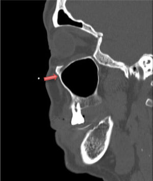 Corte sagital de TC craneal donde se visualiza fístula de LCR a nivel etmoidal (flecha).
