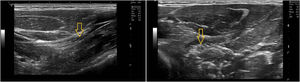 Compresión del nervio mediano a su paso entre las cabezas del músculo pronator teres, en imagen ecográfica en su eje largo (izquierda) y corto (derecha), mostrando alteración del patrón axonal con hipoecogenicidad y ligero adelgazamiento del nervio mediano en la zona de compresión.