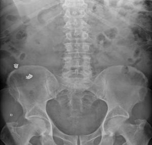 Radiografía de abdomen con cuerpos extraños metálicos en el flanco derecho.
