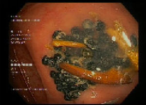 Segunda colonoscopia: cuerpos extraños en el colon que se retiran con cesta.