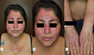 A)Pápulas y placas eritematosas y edematosas en la región facial, acompañadas de vesículas sobre una base eritematosa en la región cervical anterior. B)Lesiones faciales observadas con mayor aumento, evidenciando el componente edematoso de las mismas. C)Pápulas y placas liquenificadas en el dorso de las manos.