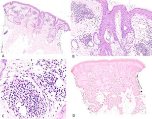 A)HE, ×2: a pequeño aumento se observa un fragmento cutáneo con inflamación de distribución perivascular y perianexial. B)HE, ×10: en relación con algunos folículos pilosos, se identifican estructuras tipo demódex. C)HE, ×20: detalle del componente inflamatorio, de tipo linfohistiocitario, con eosinófilos. D)EBER, ×2: no se observa presencia de VEB mediante HIS.