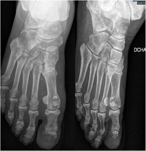 Radiografía posteroanterior y oblicua de pie derecho.