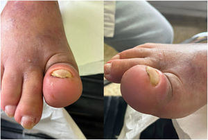Imagen de primer dedo de pie derecho con falange distal afectada por osteomielitis de pie diabético.