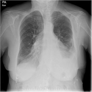 Rx tórax antero-posterior y lateral en la que se observa un derrame pleural bilateral, engrosamiento de cisuras y aumento del índice cardiotorácico concordante con cardiomegalia.