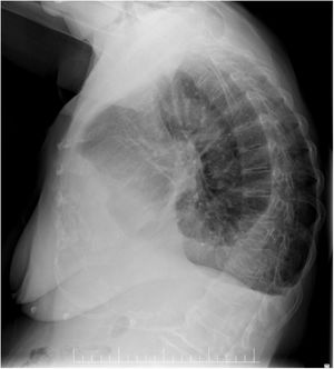 Rx tórax lateral en la que se observa un derrame pleural bilateral.