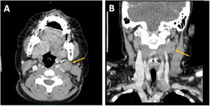 Corte axial (A) y coronal (B) de la TC cervical en la que se observa una adenopatía de gran tamaño con áreas necróticas que comprimen el paquete vascular debajo del esternocleidomastoideo (flecha amarilla).