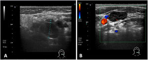 Imágenes de ecografía cervical con medición de la adenopatía de mayor tamaño (A) y con imagen Doppler (B) en las que el calibre de la vena yugular se ve disminuido por compresión.
