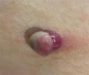 Granuloma piógeno tras administración de sal común.