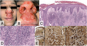 Clinical presentation and histopathological findings. (A and B) Exudative plaque measuring 4cm×2cm involving the supralabial region, nostrils and inferior pole of the nose. (C–E) Biopsy showed a dense inflammatory infiltrate in the dermis, principally lymphoplasmacytic, with a predominance of plasma cells and an increased IgG4/IgG ratio (>40%), as well as storiform fibrosis (C, H&E stain, 4×; D, H&E stain, 20×; E, Ig and IgG4 stain, 2× and 40×).