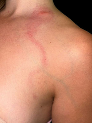 Lesión eritematosa en región cervical izquierda con trayecto lineal hacia el pectoral, compatible con el «signo de la cometa».