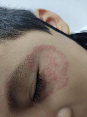 Hallazgo clínico en tiña facial por Microsporum canis. Placa eritematoescamosa anular de gran tamaño en la hemicara izquierda, con afectación malar, temporal y periorbitaria, incluyendo párpado superior.