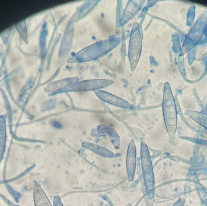 Hallazgo micológico en tiña facial por Microsporum canis. Microscopía (×100) tras tinción con azul de lactofenol mostrando macroconidios gruesos, hialinos y septados (6-8 tabiques), característicos de M. canis.