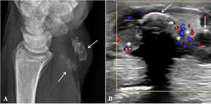 A) Radiografía simple de muñeca izquierda, proyección lateral. Numerosos focos nodulares calcificados, de tamaño pequeño y uniforme (flechas blancas), en las proximidades de la articulación radiocubitocarpiana. B) Ecografía de muñeca izquierda. Aumento de vascularización de las estructuras sinoviales (asteriscos) adyacentes a los focos de calcificación (flechas blancas).