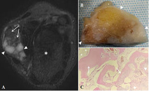 A) RM de muñeca izquierda, imagen axial potenciada en T2. Hiperintensidad de señal típica de estructuras cartilaginosas (puntas de flecha) entre nódulos osificados (flechas blancas), adyacentes a la articulación radiocubitocarpiana (asterisco). B) Pieza quirúrgica, masa indurada con áreas blanquecinas nacaradas de aspecto cartilaginoso (puntas de flecha). C) Análisis histológico (hematoxilina-eosina, ×10). Nódulos de cartílago maduro (puntas de flecha) en continuidad con trabéculas óseas maduras con osificación endocondral (flechas), entre tejido adiposo periférico (asterisco).