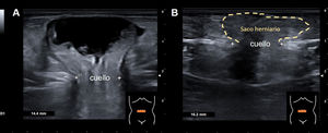 A) Imagen ecográfica en plano transversal sobre la región umbilical, obtenida con sonda lineal, donde se observa un defecto peritoneal de unos 14mm, con protrusión de un asa de intestino delgado a través del mismo. No se aprecia líquido libre alrededor del asa. B) Imagen tras la maniobra de reducción ecoasistida, mostrando el saco herniario, sin contenido intestinal residual.