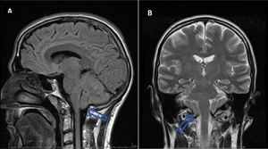 MRI brain: (A) T2 flair sagittal plane. (B) T2 coronal plane. Presence of bilateral cerebellar tonsillar ectopia without secondary hydrocephalus or upper cervical syrinx.