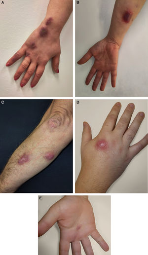 A y B. Mujer de 47 años que presenta una placa eritematoedematosa con microvesículas y pústulas en el dedo meñique derecho, acompañada de nódulos eritemato-violáceos en el brazo ipsilateral, siguiendo un patrón esporotricoide. C. Varón de 30 años con 2 nódulos inflamatorios eritematovioláceos en la parte posterior del antebrazo izquierdo. D y E. Varón de 42 años con un nódulo eritematoso de 1,5cm de diámetro en el dorso de la mano derecha y una úlcera milimétrica en la palma de la misma mano.