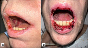 Afectación grave de la mucosa oral: a y b) Se aprecia denudación de mucosa yugal, dorso lingual y lesiones erosivo-costrosas en labios.